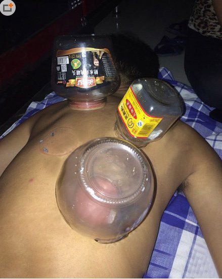 大學(xué)生奇葩搞笑的拔火罐